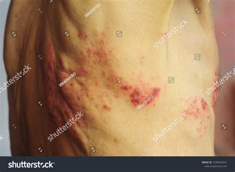 Raised Red Bumps Blisters Caused By Stock Photo 1438435457 Shutterstock
