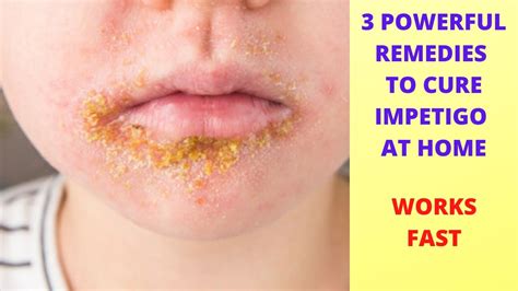 Impetigoimpetigo Home Remediesecthyma Gangrenosumimpetigo Treatment