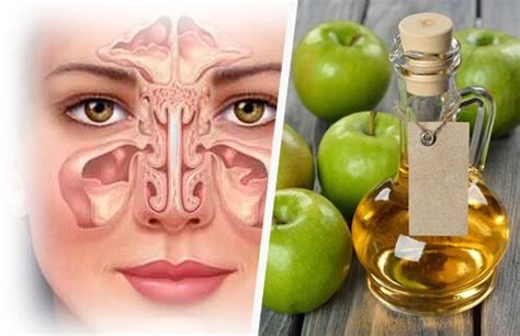 Mar 11, 2021 · sind alle nasennebenhöhlen entzündet, liegt eine pansinusitis vor. Hausmittel gegen verstopfte Nasennebenhöhlen - Besser ...