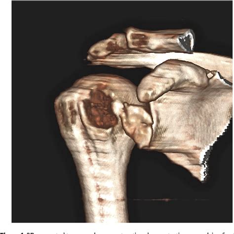Figure 1 From Reconstruction Of A Massive Avulsion Fracture Of The