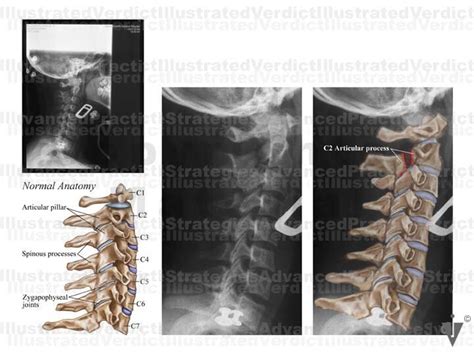 Stock Spine Cervical Spine — Illustrated Verdict