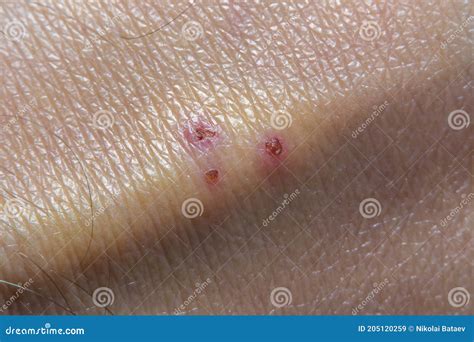 Background With Close Up Of Human Skin With A Protruding Vein And