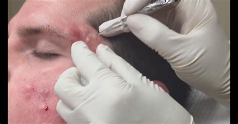 Dr Pimple Popper Youtube 2019 Blackheads Removal