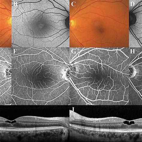 A Case Of Macular Telangiectasia Type 2 Without Late Phase