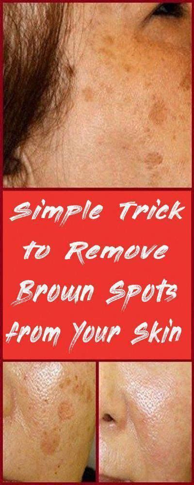 Pin On Brown Spots On Face