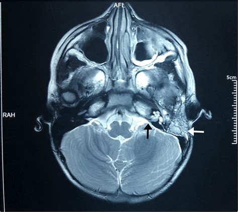 Contrast Enhanced Mri Brain Demonstrating Left Mastoiditis White Arrow