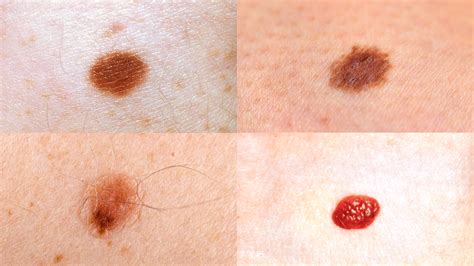 Skin Moles Types