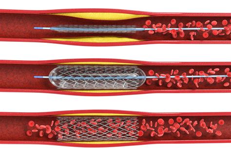 Stent Treatment Options Abiomed