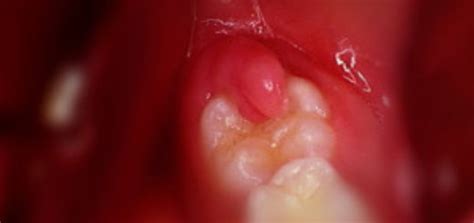 Pericoronitis Archives Dr Sunil Dental Blog