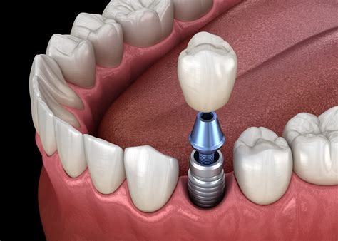 Common Dental Implant Terms You Should Know