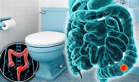 Bowel Cancer Symptoms Thin Poo And Stools Could Be A Sign Of Disease