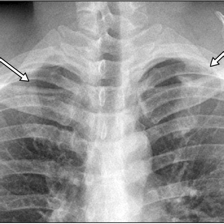 A Right First Rib Stress Fracture White Arrow In Axial Image Of