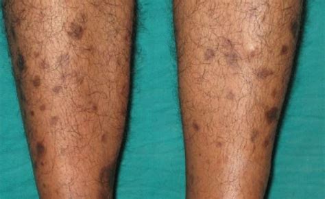 Brown Spots On Legs Lower Legs Get Rid Of Babe Light Brown Dots On