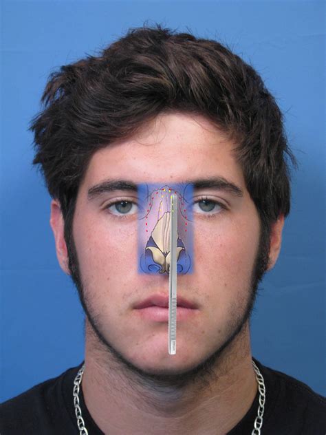 Rhinoplasty Crooked Nose Surgery Dr Hilinski