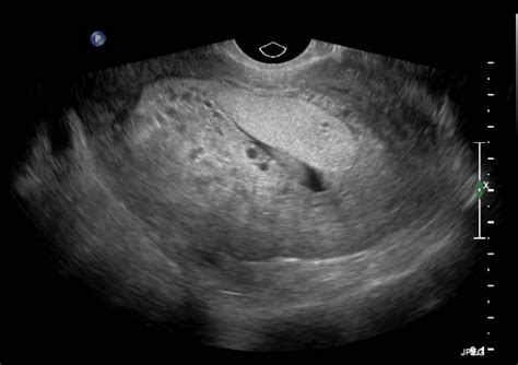 Ultrasound Case Of The Month Hydatidiform Mole — Brown Emergency Medicine
