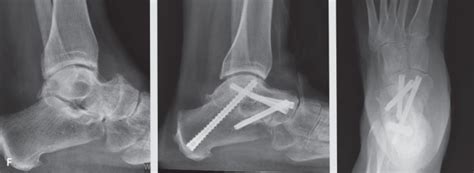 Triple Arthrodesis Musculoskeletal Key