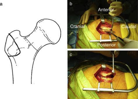 Reattachment Of An Osteotomized Greater Trochanter In Total Hip