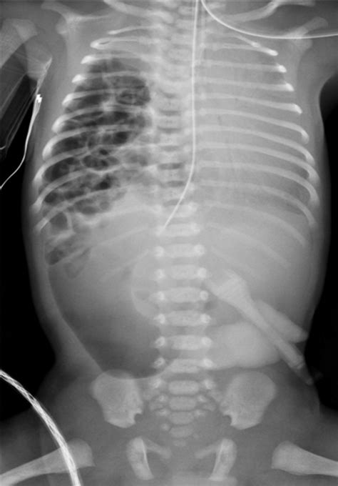 Chest Radiograph At Birth Showing Right Sided Congenital Diaphragmatic