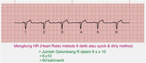 A v n r t 3. Interpretasi EKG 5 Langkah