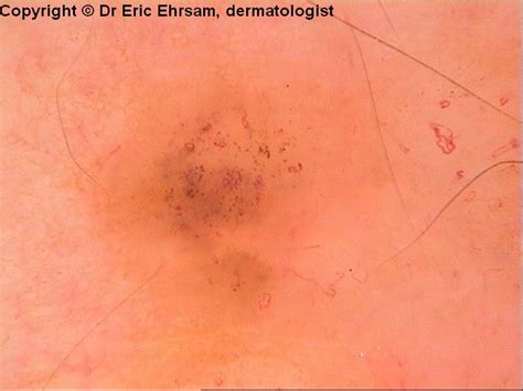 Dermoscopy Basal Cell Carcinoma