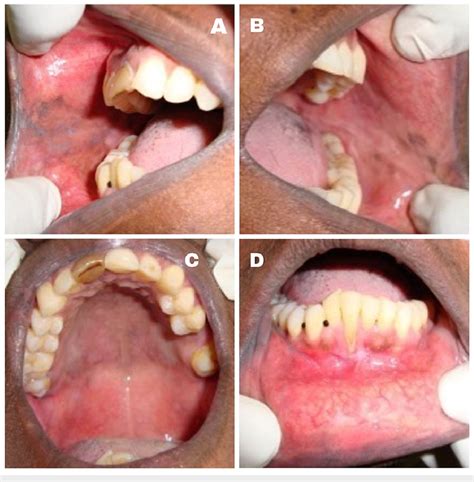 Completely Healed Lesions In Right A And Left B Buccal Mucosa Soft