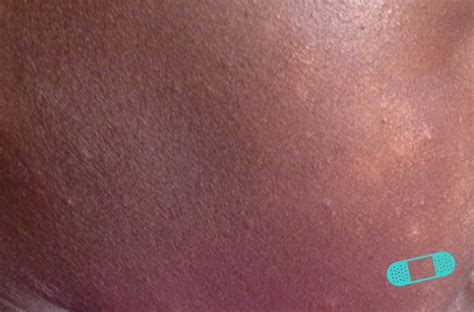 What exactly triggers the skin rash? Online Dermatology - Pityriasis Alba