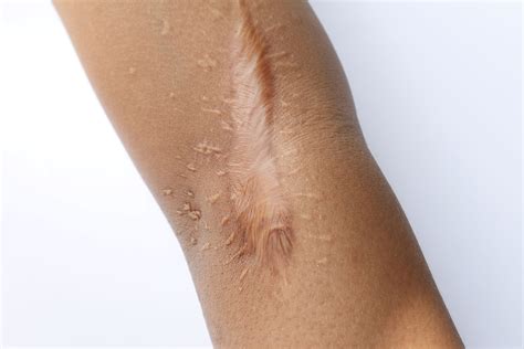 Keloid Vs Hypertrophic Scar What You Need To Know Dermalmedix