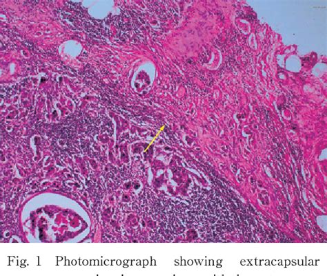 Figure 1 From Rate Of Metastasis In Examined Lymph Nodes As A Predictor