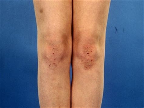 Dermatite erpetiforme - Dermatiti - Cosa è la dermatite ...