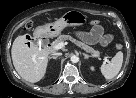 Gallstone Ileus A Radiographic Diagnosis Confirmed By Ct Eurorad
