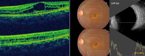 Maculoschisis Juvenile Oct And B Scan Tropical Ophthalmology