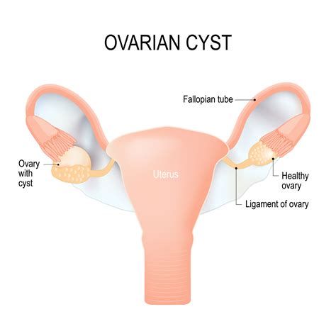ovarian cyst removal melbourne ovarian cystectomy — a prof alex ades