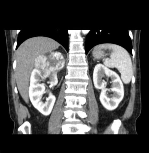 Renal Cell Carcinomas Rcc Are Malignant Tumours Derived From The