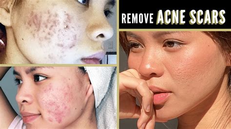 How To Get Rid Of Pimple Scars