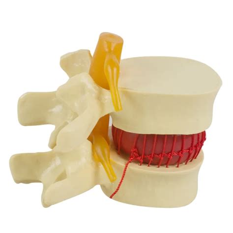 Medical Spine Lumbar Disc Herniation Model Demonstration Model