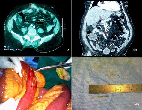 Non traitée, elle peut être mortelle, principalement par péritonite et sepsis ; Pan African Medical Journal - Test your knowledge with clinical images quiz