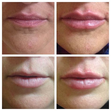 Lips Filler