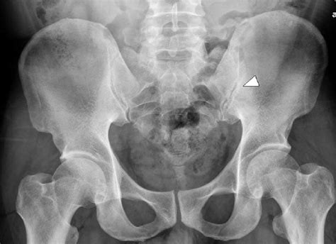Sacroiliac Joint X Ray View