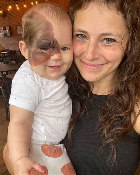 mom made it mission to show daughter with rare birthmark her beauty viralbandit