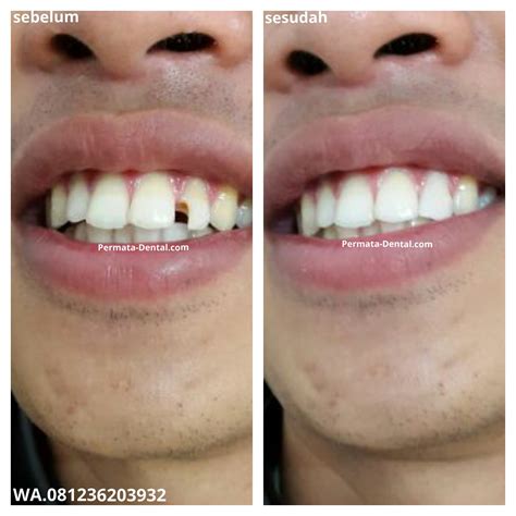 Dokter Gigi Denpasar Bali | Permata Dental: PERBAIKI GIGI PATAH DI