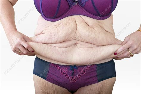 Woman With Excess Skin After Weight Loss Stock Image C Science Photo Library