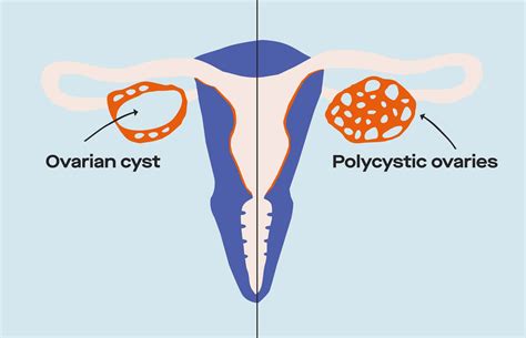 Whats The Difference Between Ovarian Cysts And Pcos