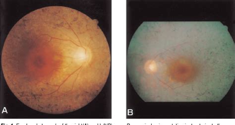 Figure 1 From Bilateral Spontaneous Dislocation Of Intraocular Lenses
