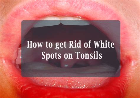 How To Get Rid White Spots On Tonsils Images And Photos Finder
