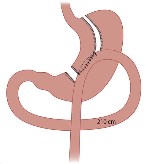 Illustration Of The One Anastomosis Gastric Bypass Technique Download Scientific Diagram