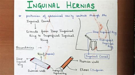 Inguinal Hernias Indirect And Direct Types Part 1 Youtube