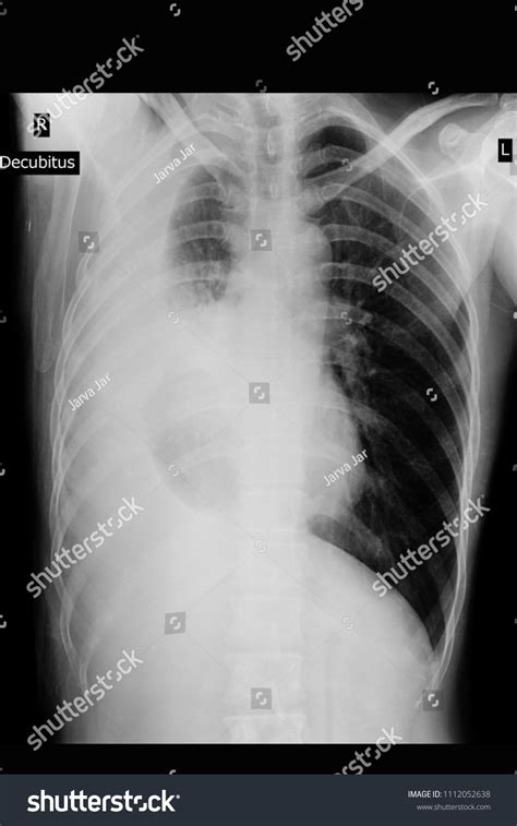 Chest Xray Decubitus Show Infiltration Right Foto Stock 1112052638