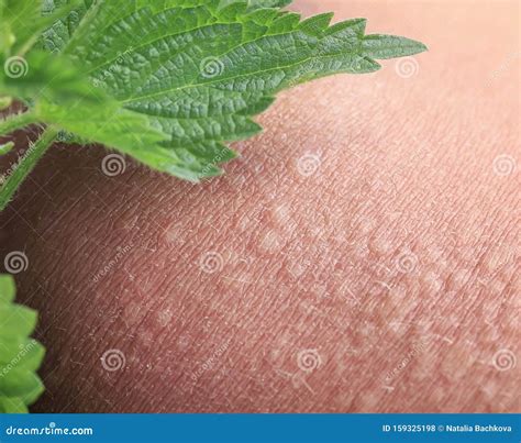 Stinging Nettle Lying On Irritated Human Skin Covered With Small