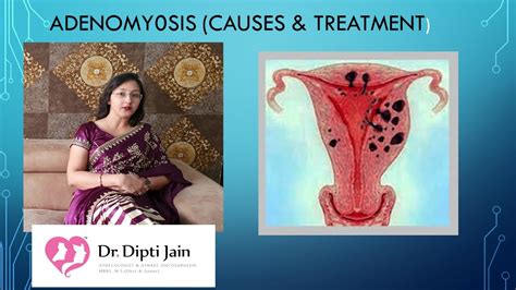What Is Adenomyosis And What Is The Treatment For It Youtube