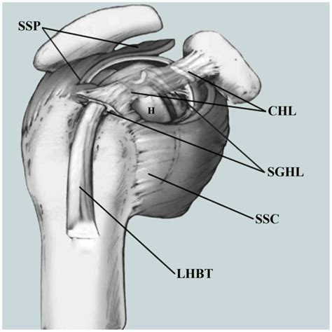 Smallincision Open Distal Subpectoral Vs Arthroscopic Proximal Biceps Tenodesis For Biceps